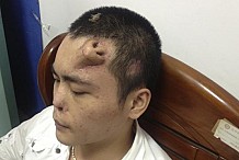 Un Chinois défiguré se fait pousser son futur nez sur le front